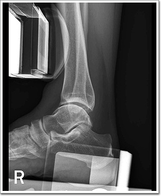 Ankle Anterior Posterior Drawer